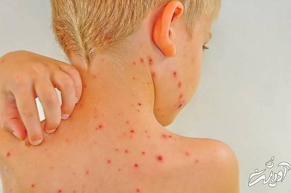 پیشگیری آبله مرغان